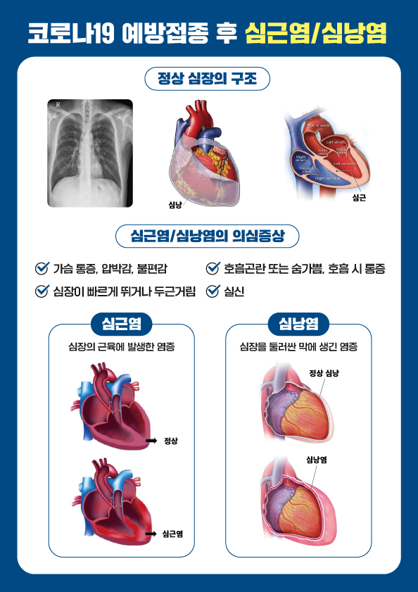 코로나19 예방접종 후 심근염/심낭염이란?